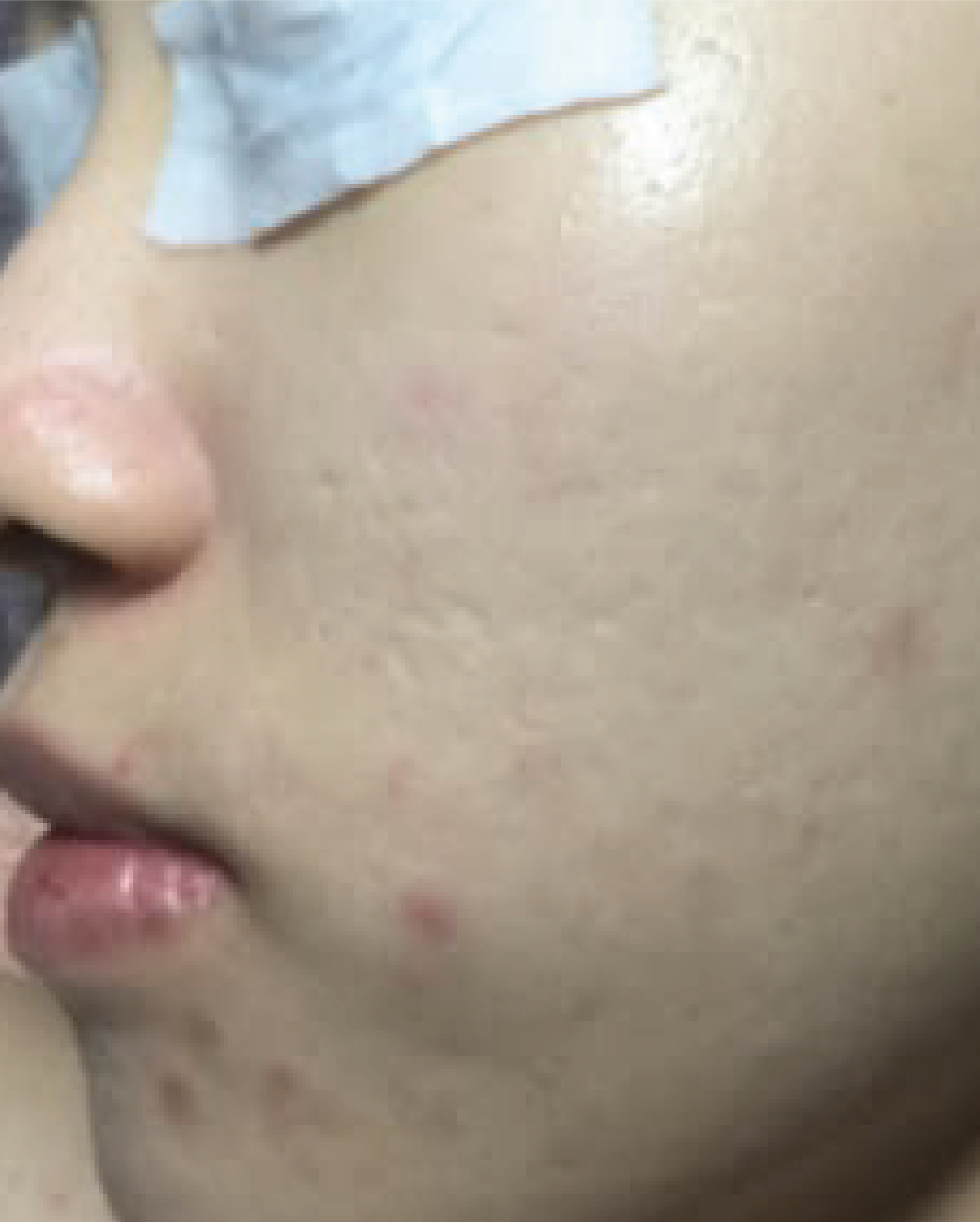 After photo for Acne Marks Recovery