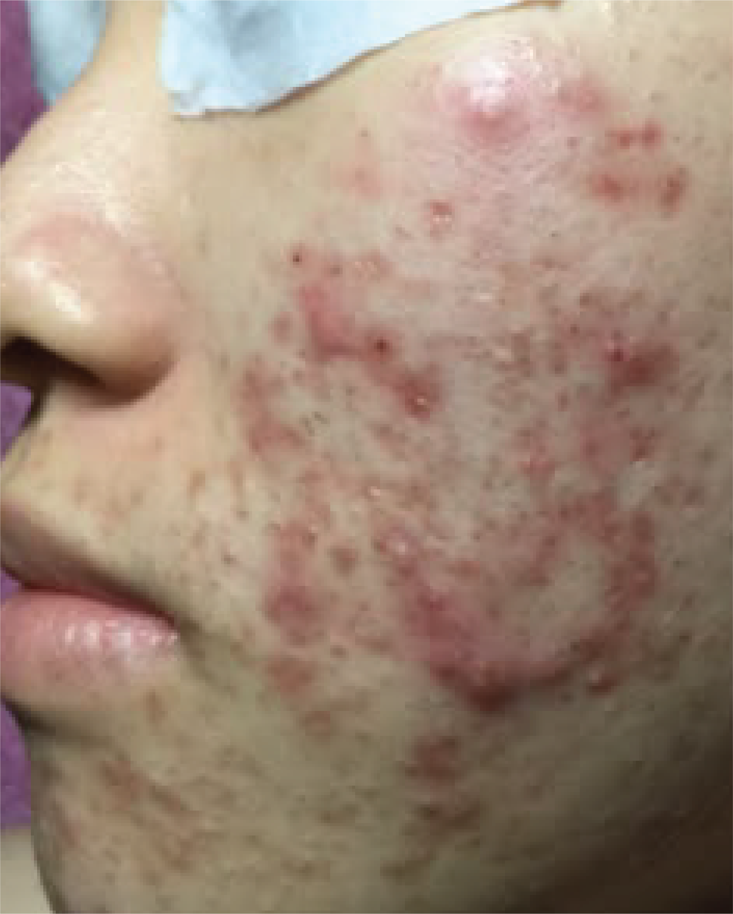 Before photo for Acne Marks Recovery